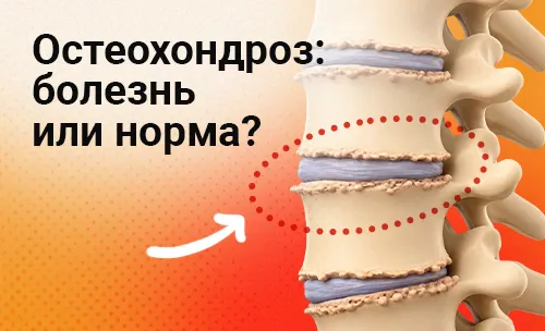 Остеохондроз: болезнь, возрастная норма или находка на МРТ?