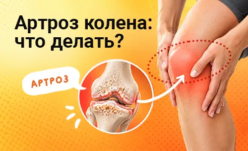 Гонартроз коленного сустава: симптомы и лечение артроза колена